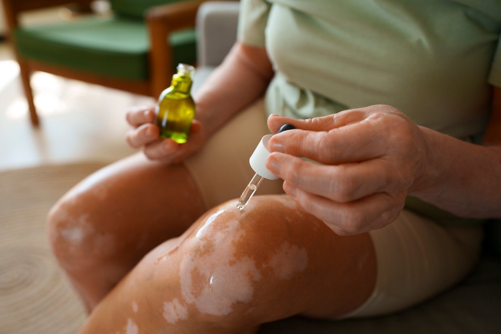Homeopathy for Skin Diseases: A Natural Approach to Healthy Skin